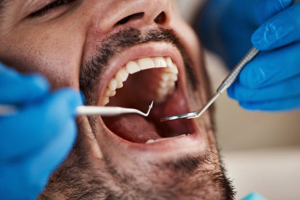 Best Emergency Wisdom Teeth Removal in Bessemer City, NC